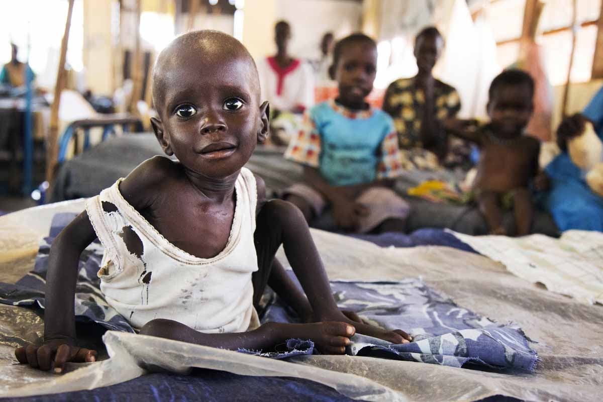 Aleo Tong (1), who suffers severe malnutrition, rests on a bed at the MSF Nutrition centre in Aweil Hospital, on 2 August, 2016.