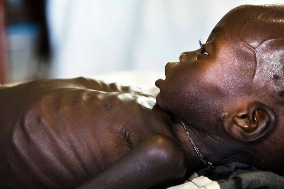 This file photo taken on October 11, 2016 shows Agop Manut (11 months), who suffers acute malnutrition and respiratory distress, assisting at the clinic run by Doctors without Borders (MSF) in Aweil, Northern Bahr al Ghazal, South Sudan.