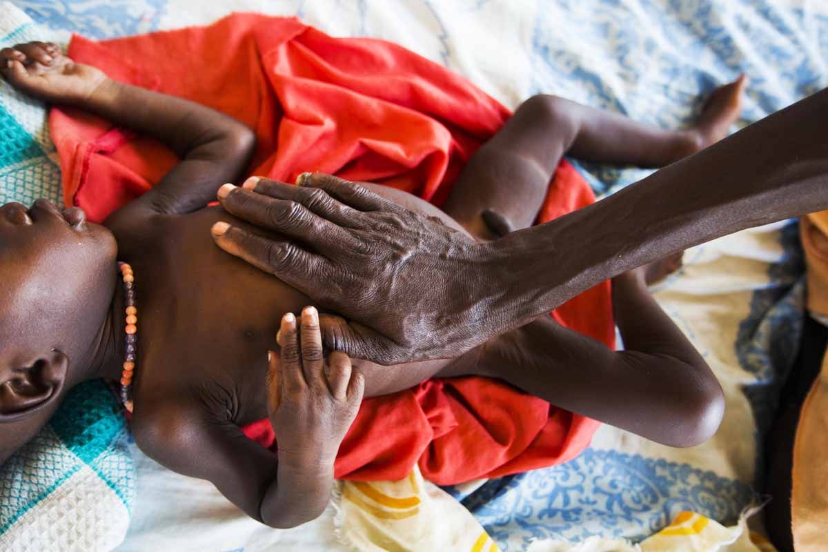 A 11-month-old boy with a severe malnutrition rests while is mother comforts him on October 9, 2015 at the Aweil State Hospital, in Aweil, Northern Bahr El-Gazhal.