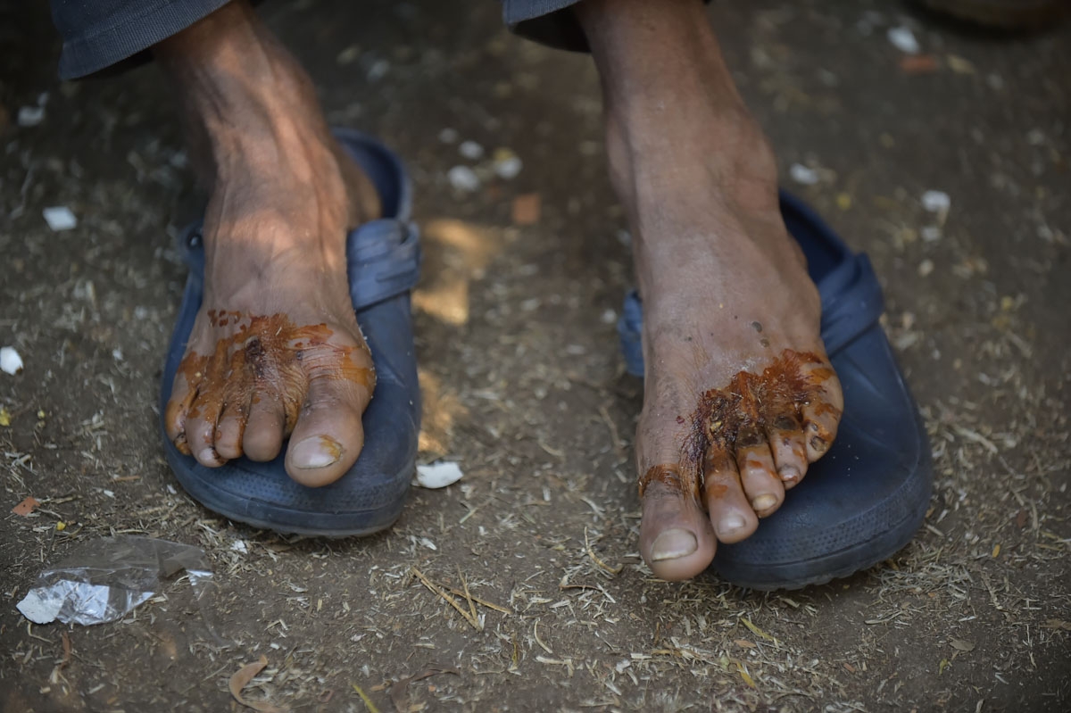 Venezuelan migrant Jose Carrizales' shows his feet at a makeshift camp near the bust terminal in northern Quito, Ecuador, August 9, 2018.